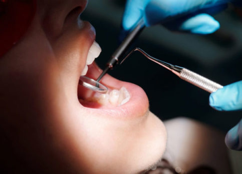 Close-up of dentist hands using dental tools in patient's mouth