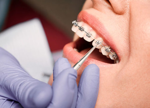 Close-up of orthodontist hand with tool adjusting braces in patient's mouth